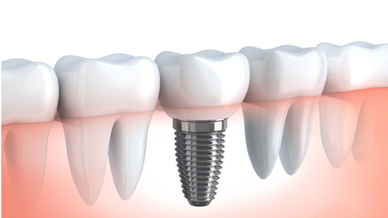 What are Dental Sealants?