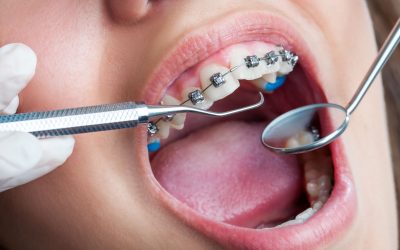 Enjoy a Confident Smile with Dental Braces Buckner KY Patients Trust for Lasting Results